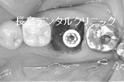 歯茎を切らないフラップレスで左下奥歯にインプラント1本埋入