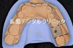 歯茎を切らないフラップレスで左下奥歯にインプラント1本埋入
