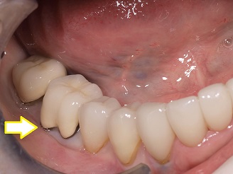 治療期間を短くするために右下奥歯1本を抜歯した後インプラントを即時埋入した症例