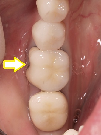 治療期間を短くするために右下奥歯1本を抜歯した後インプラントを即時埋入した症例