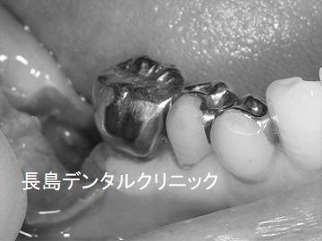 他院で右下奥歯を抜歯した部位にインプラントを埋入した症例