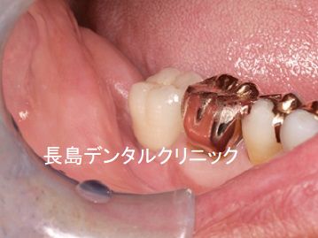 他院で右下奥歯を抜歯した部位にインプラントを埋入した症例
