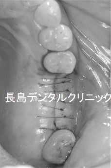 右上奥歯に上顎洞に人工骨を補填せずインプラントを埋入した症例