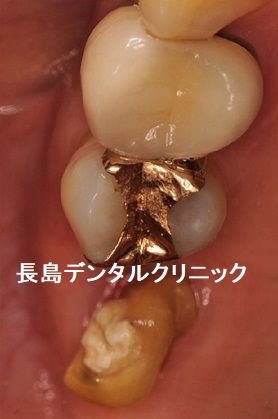 右上奥歯に残っている歯根を抜歯しインプラントを即時埋入した症例