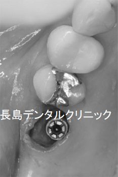 右上奥歯に残っている歯根を抜歯しインプラントを即時埋入した症例