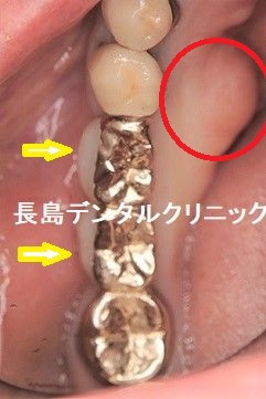 骨隆起があり、噛みしめる力が強いと予想される患者様にインプラントの被せ物が壊れないよう配慮した症例