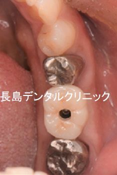 左下奥歯を1歯抜いて即日インプラントを埋入した症例