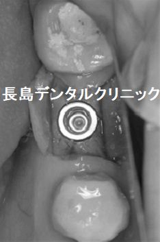 奥歯のブリッジが虫歯になり、再度ブリッジで治療せずインプラントで対応した症例