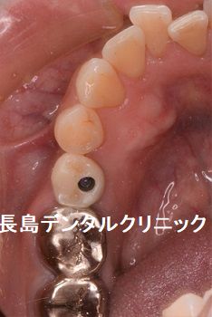 右下奥歯1本欠損部位にインプラントを埋入した症例
