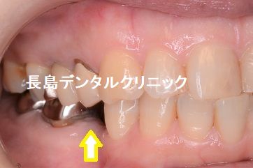 右下奥歯1本欠損部位にインプラントを埋入した症例