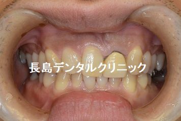 左下奥歯1本欠損部位にインプラントを埋入した症例