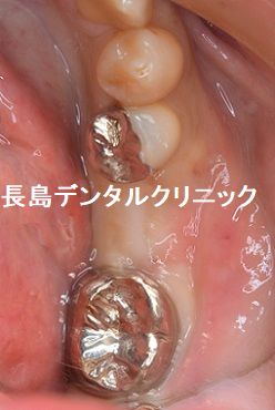 左下奥歯1本欠損部位にインプラントを埋入した症例