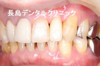 歯周病が進んだ左上前歯をインプラント埋入まで抜歯せず抜歯即時インプラント埋入を行った症例