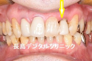 歯周病が進んだ左上前歯をインプラント埋入まで抜歯せず抜歯即時インプラント埋入を行った症例