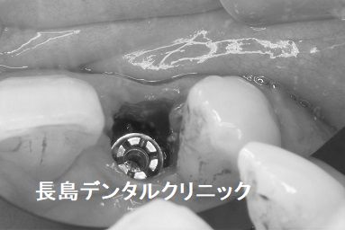 歯周病が進んだ左上前歯をインプラント埋入まで抜歯せず抜歯即時インプラント埋入を行った症例