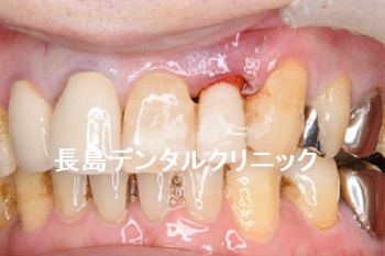 歯周病が進んだ左上前歯をインプラント埋入まで抜歯せず抜歯即時インプラント埋入を行った症例