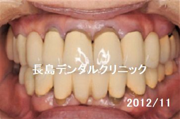 10年経過したフルマウス症例（上下すべての歯を抜歯しインプラントブリッジを装着した症例）