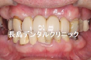重度歯周病の為上の歯を全て抜歯し6本のインプラントを使いインプラントブリッジを装着した症例
