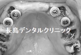 重度歯周病の為上の歯を全て抜歯し6本のインプラントを使いインプラントブリッジを装着した症例