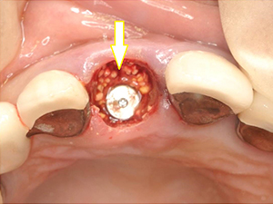 インプラント埋入