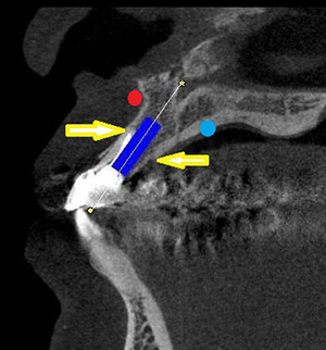 CTによる術前のインプラントシュミレーション画像