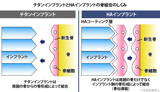 チタンインプラント HAインプラント