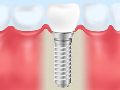 インプラント周囲炎を防ぐ方法