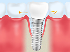 インプラント周囲炎を防ぐ方法